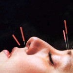 Is Acupuncture For You?